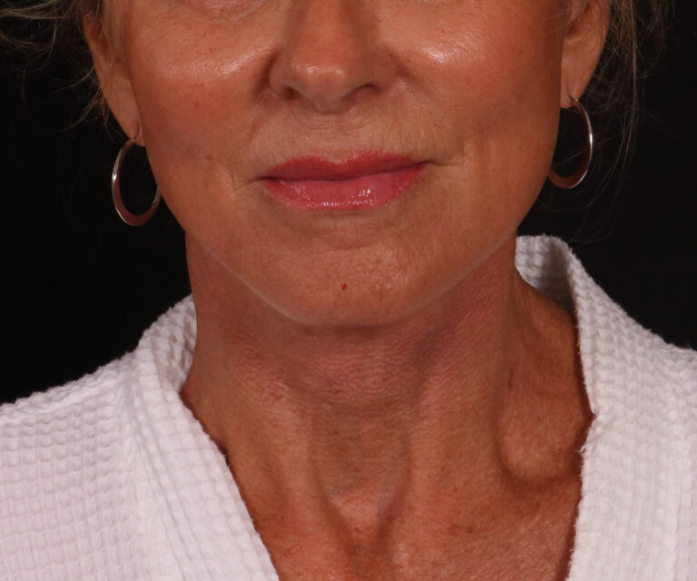 After Image: Lower Facelift - front