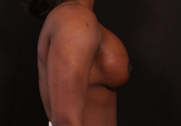 Before Image: Secondary Breast Enhancement - right-side