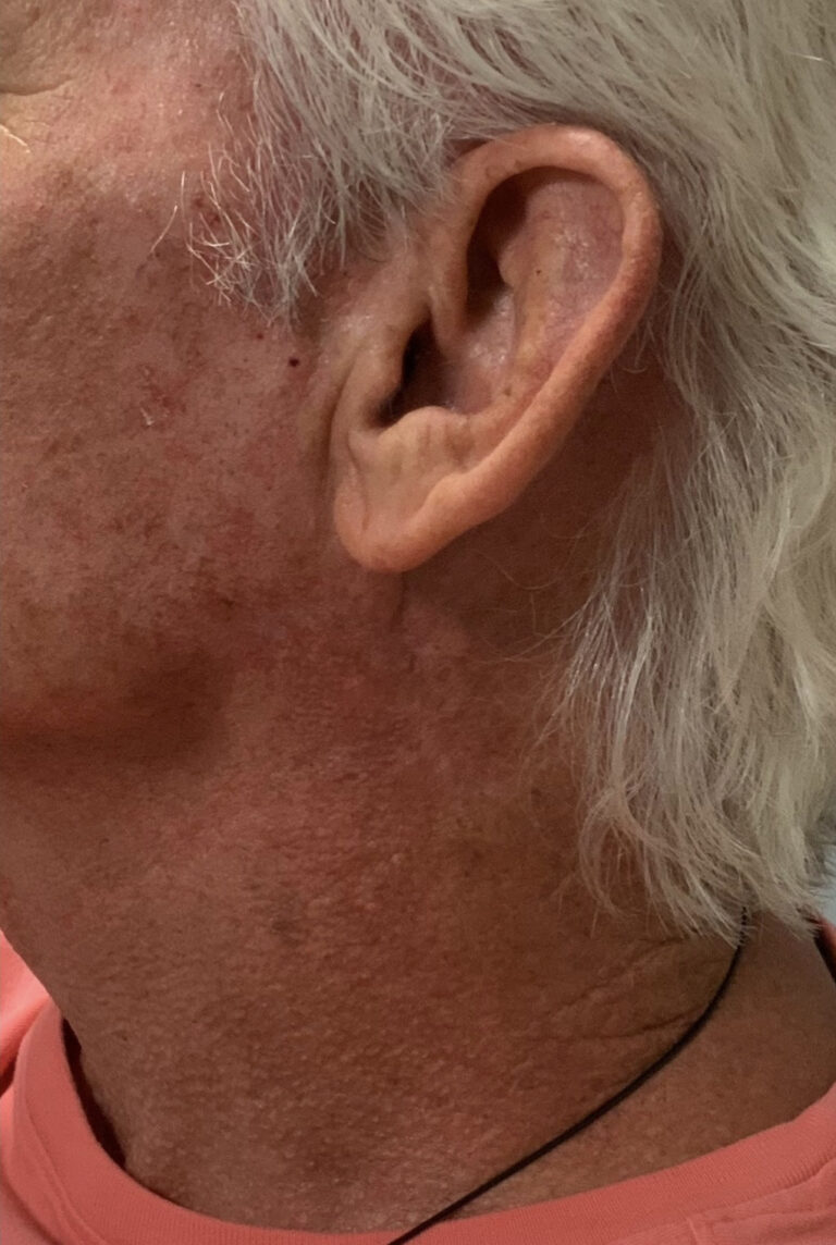 After Image: Mohs Closure - left-side