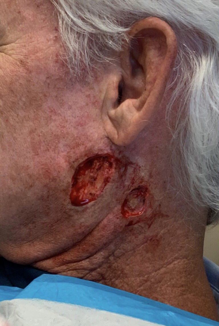 Before Image: Mohs Closure - left-side