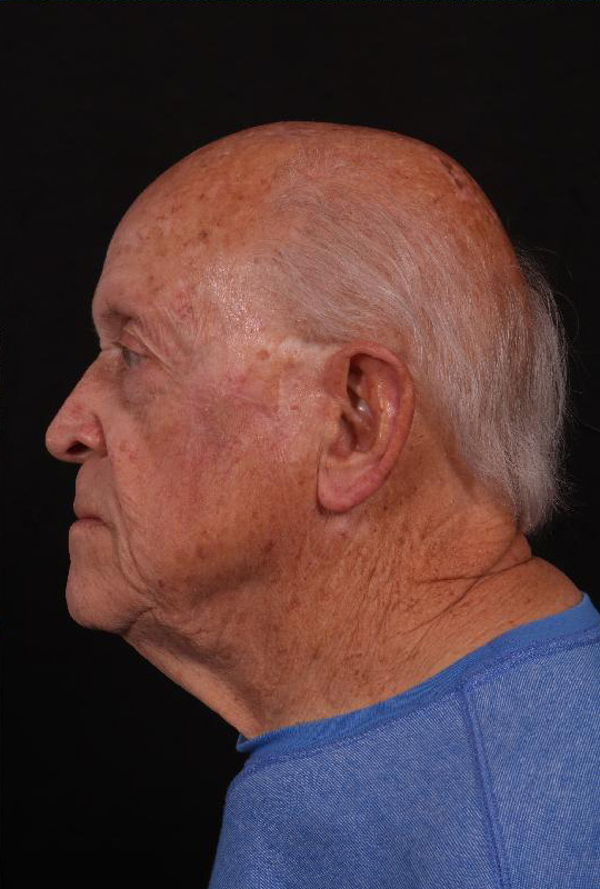 After Image: Mohs Closure - left-side