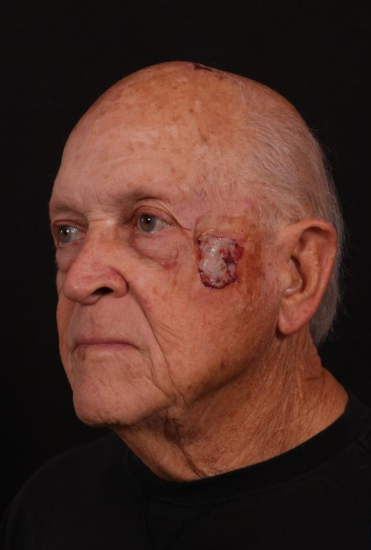 Before Image: Mohs Closure - left-front-oblique