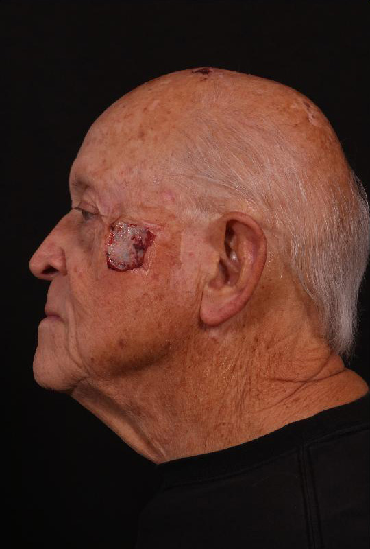 Before Image: Mohs Closure - left-side
