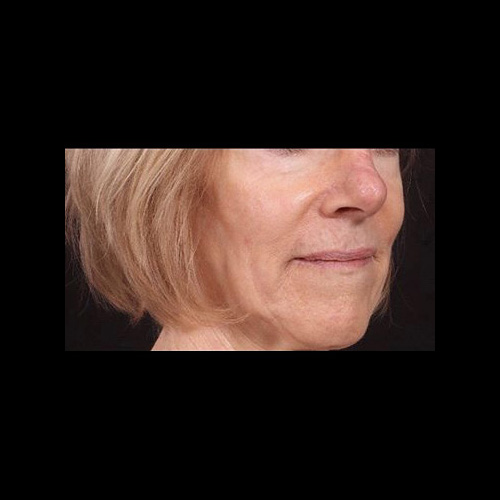 After Image: Mohs Closure - right-front-oblique