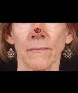 Before Image: Mohs Closure