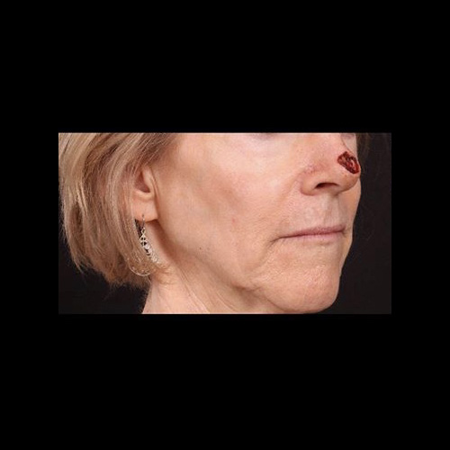 Before Image: Mohs Closure - right-front-oblique
