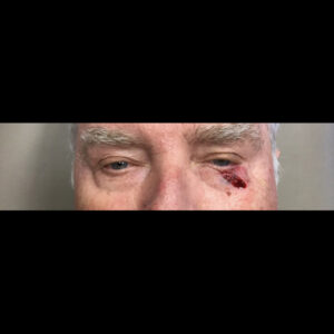 Before Image: Mohs Closure