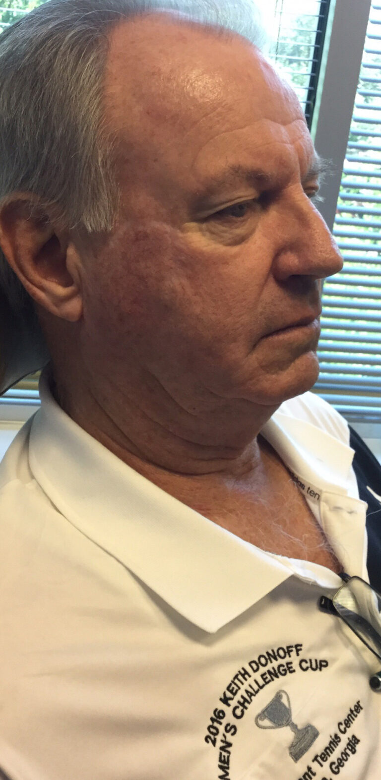 After Image: Mohs Closure - right-front-oblique