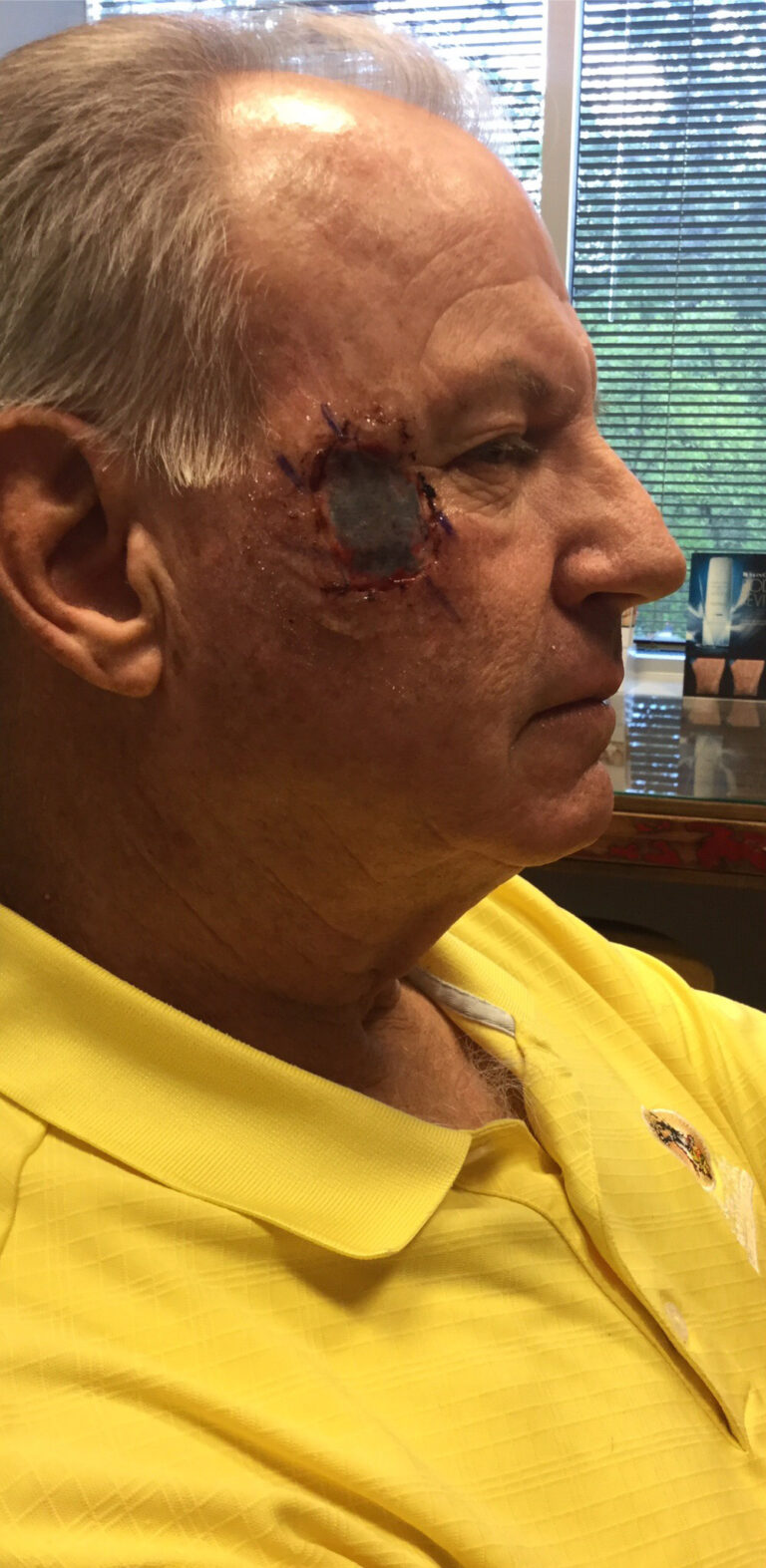 Before Image: Mohs Closure - right-front-oblique