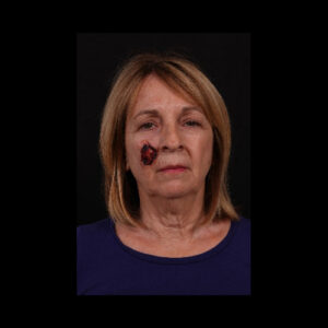 Before Image: Mohs Closure