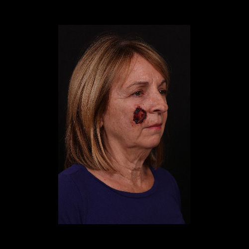 Before Image: Mohs Closure - right-front-oblique
