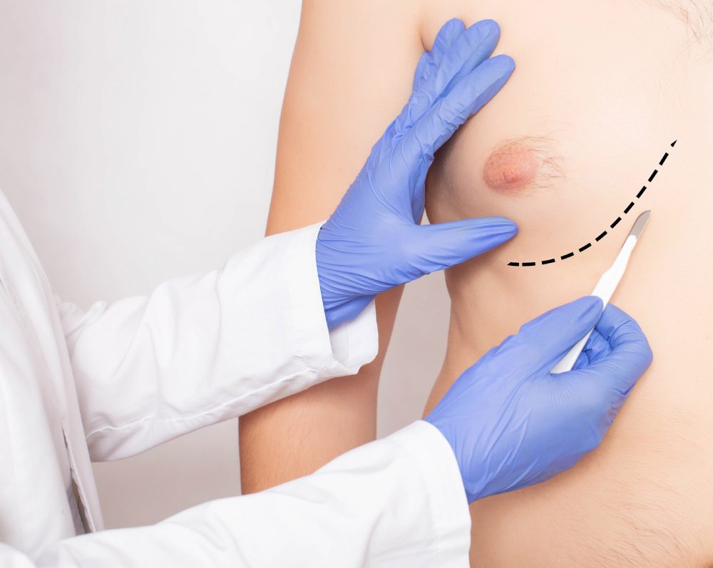 Gynecomastia Surgery Bee Cave TX