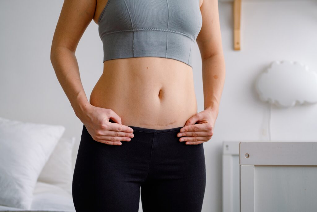 Close up of woman’s midsection, as she reveals scarring from tummy tuck surgery