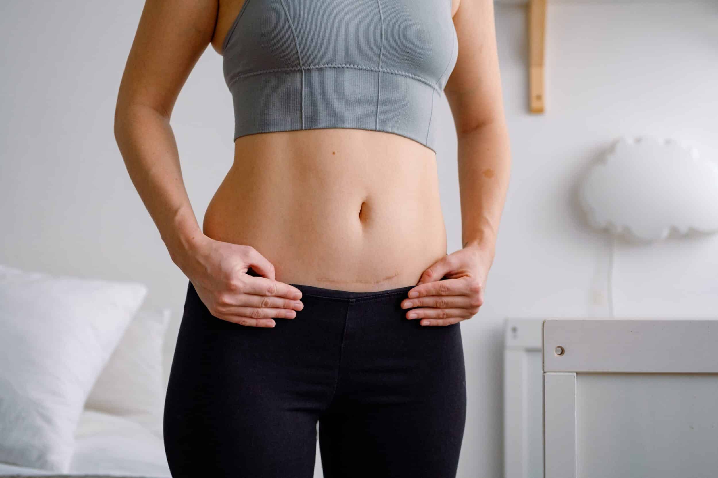Close up of woman’s midsection, as she reveals scarring from tummy tuck surgery