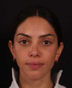 After Image: Rhinoplasty