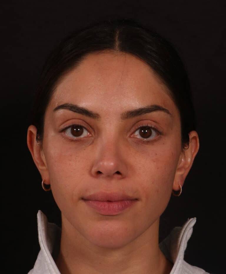 After Image: Rhinoplasty - front