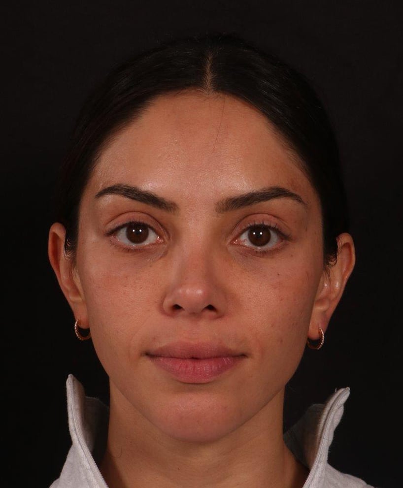 After Image: Rhinoplasty - front
