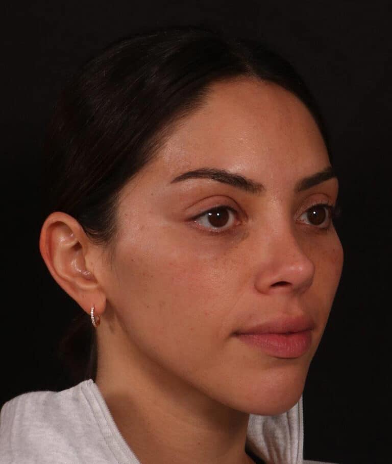 After Image: Rhinoplasty - right-front-oblique