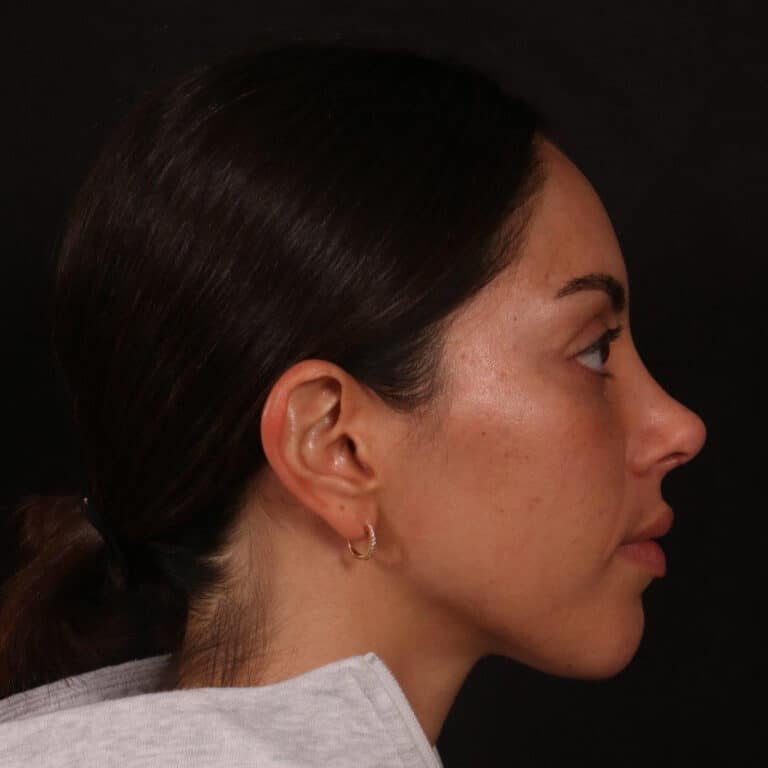 After Image: Rhinoplasty - right-side