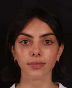 Before Image: Rhinoplasty