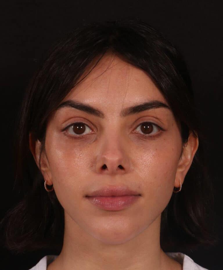 Before Image: Rhinoplasty - front