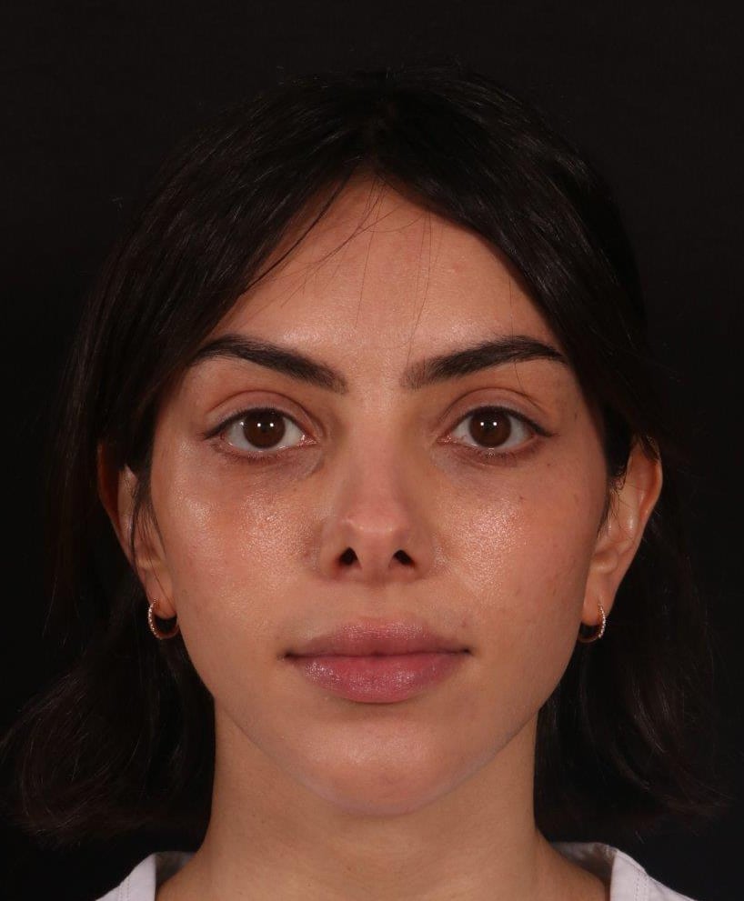 Before Image: Rhinoplasty - front