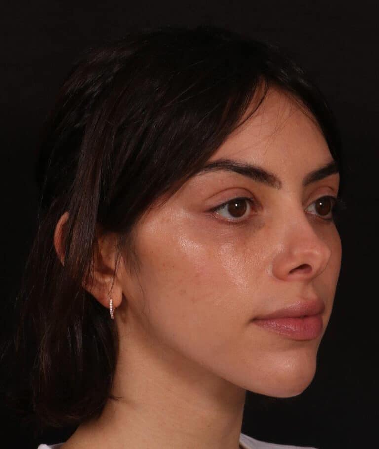 Before Image: Rhinoplasty - right-front-oblique