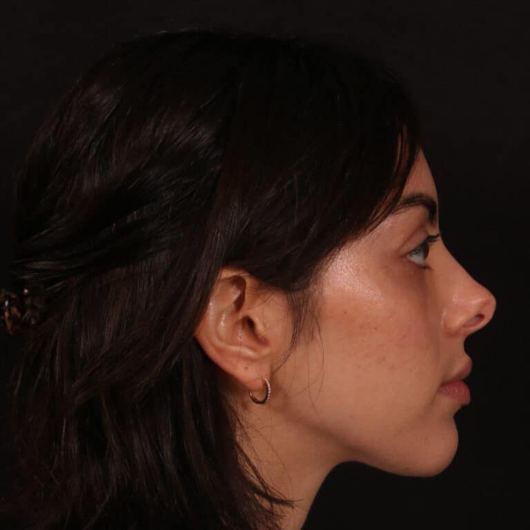 Before Image: Rhinoplasty - right-side