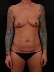 Before Image: Mommy Makeover