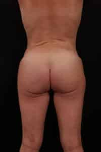 After Image: Brazilian Butt Lift