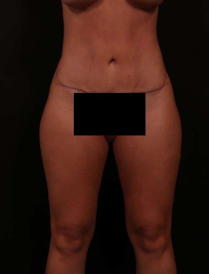 After Image: Tummy Tuck (Abdominoplasty) - front