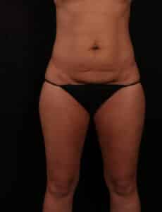 Before Image: Tummy Tuck (Abdominoplasty)