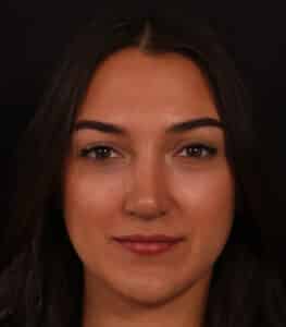 After Image: Rhinoplasty/Septoplasty