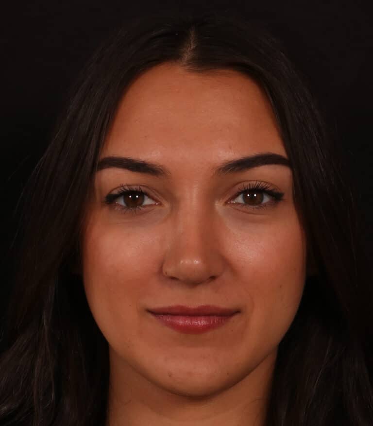 After Image: Rhinoplasty/Septoplasty - front