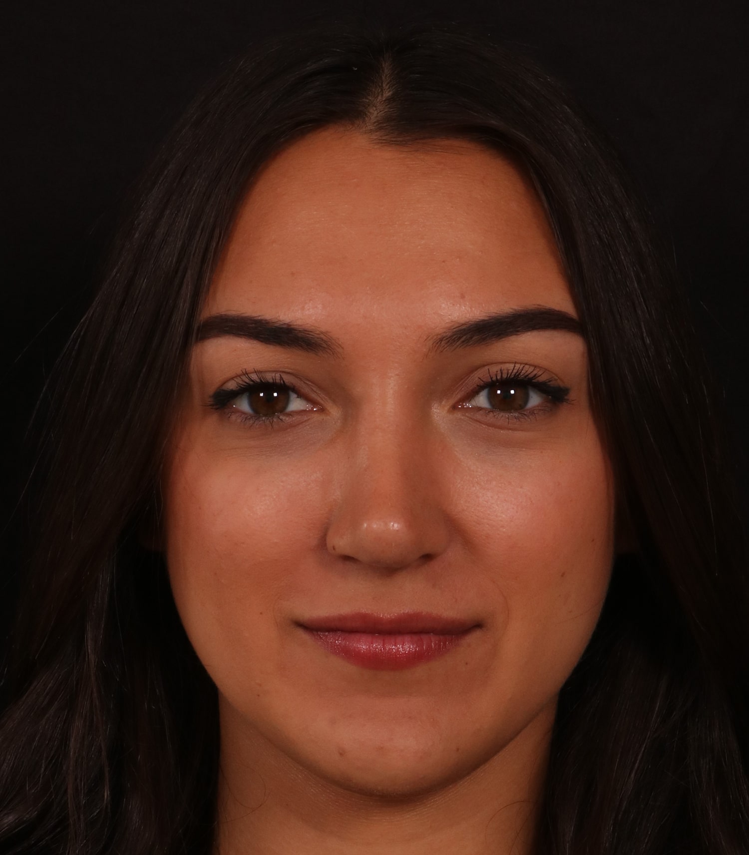 After Image: Rhinoplasty/Septoplasty - front