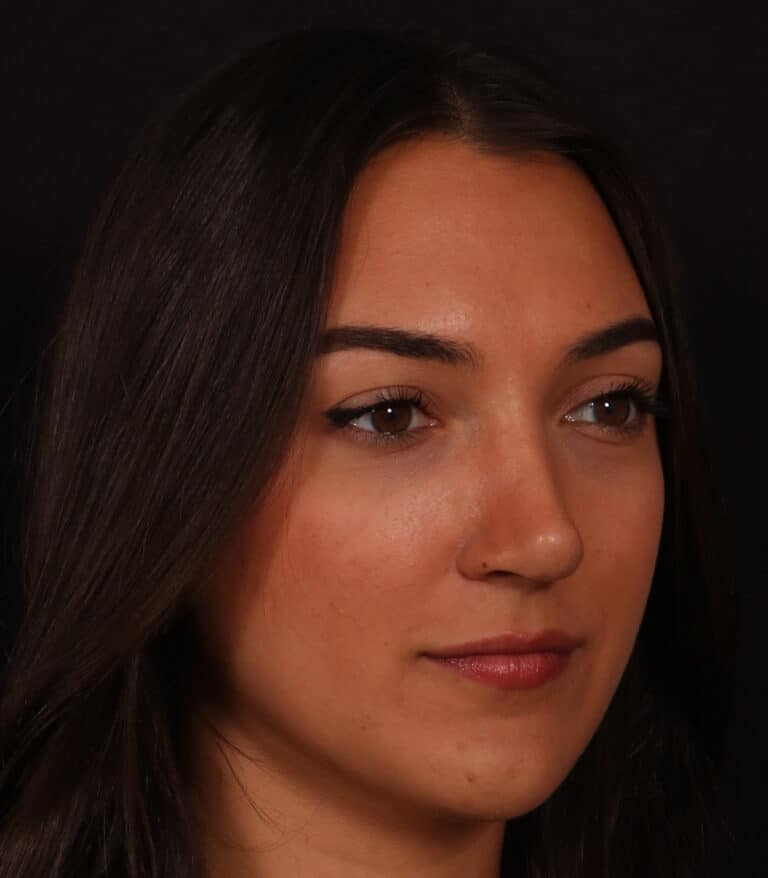 After Image: Rhinoplasty/Septoplasty - right-front-oblique