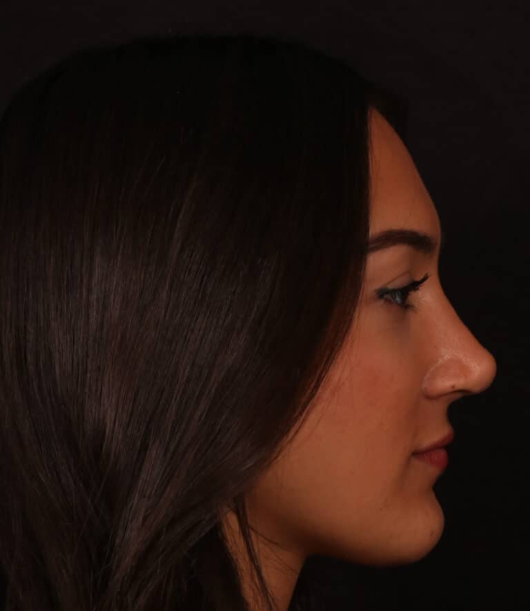 After Image: Rhinoplasty/Septoplasty - right-side