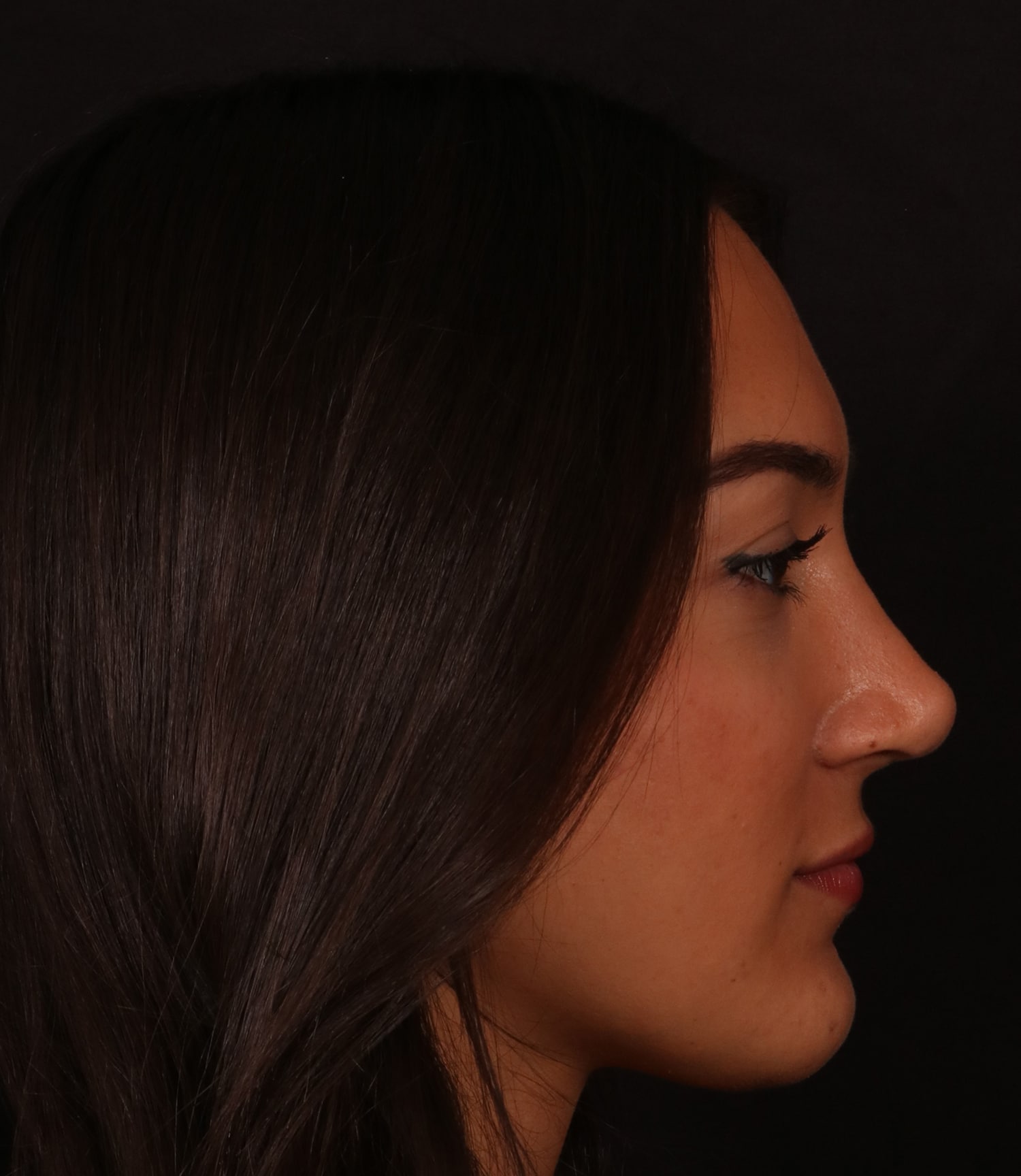 After Image: Rhinoplasty/Septoplasty - right-side