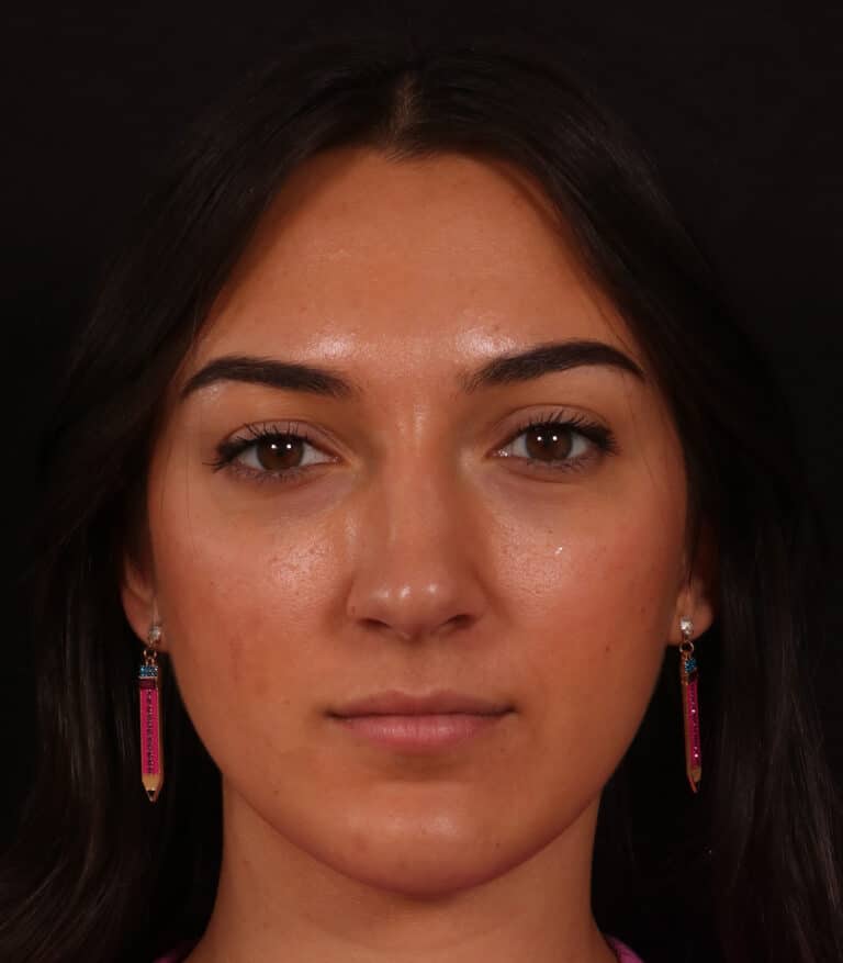 Before Image: Rhinoplasty/Septoplasty - front