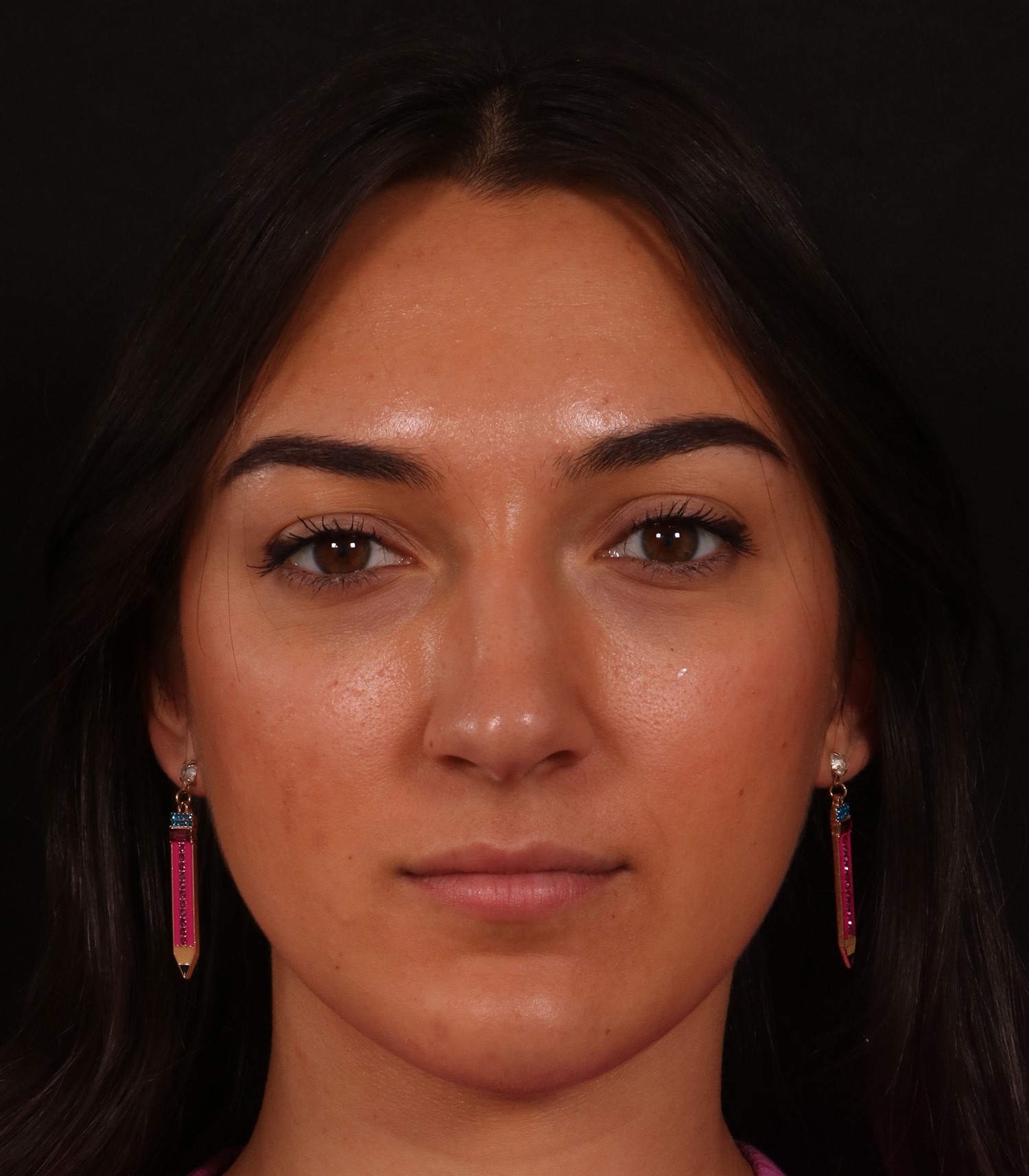 Before Image: Rhinoplasty/Septoplasty - front