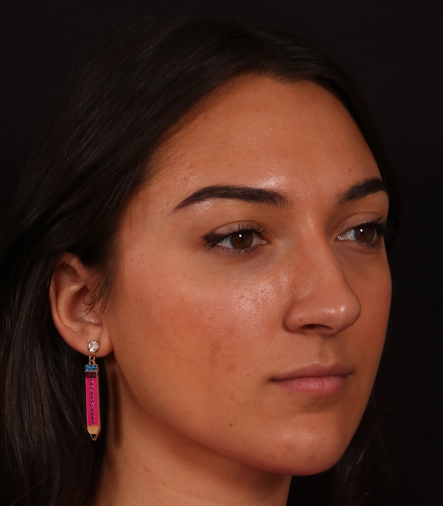Before Image: Rhinoplasty/Septoplasty - right-front-oblique