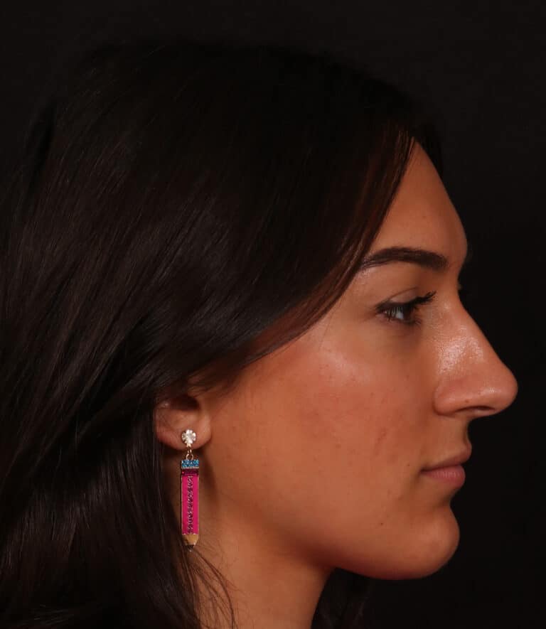 Before Image: Rhinoplasty/Septoplasty - right-side