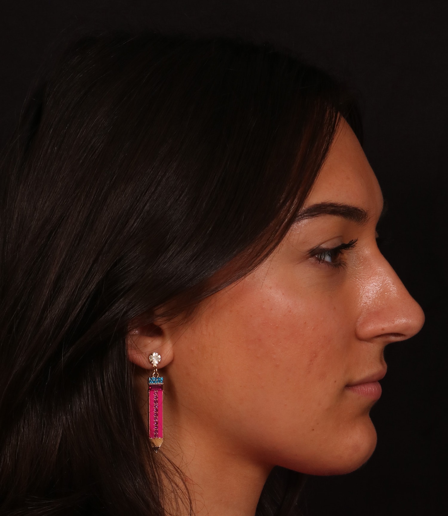 Before Image: Rhinoplasty/Septoplasty - right-side