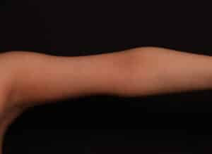 After Image: Brachioplasty