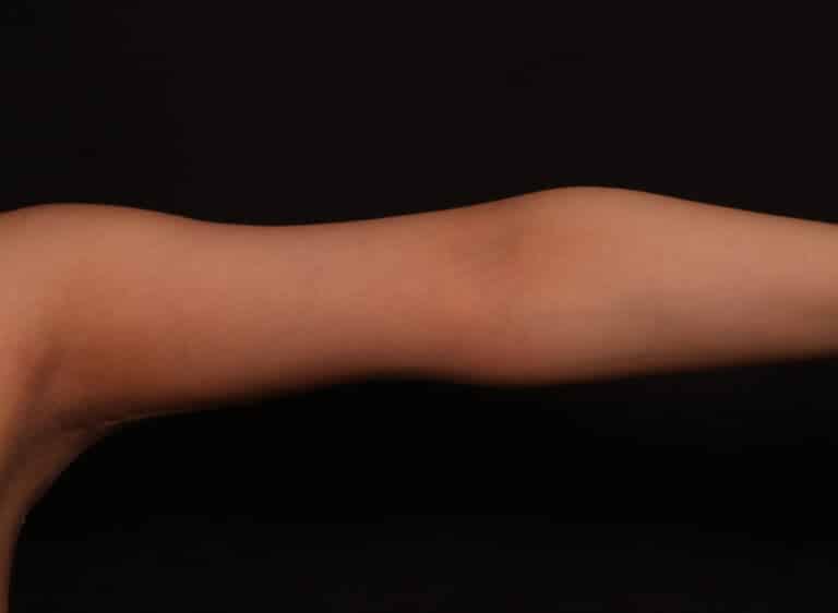 After Image: Brachioplasty - front