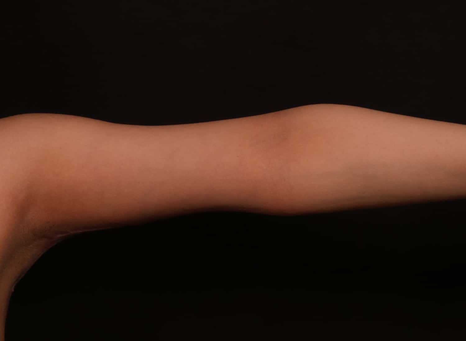 After Image: Brachioplasty - front