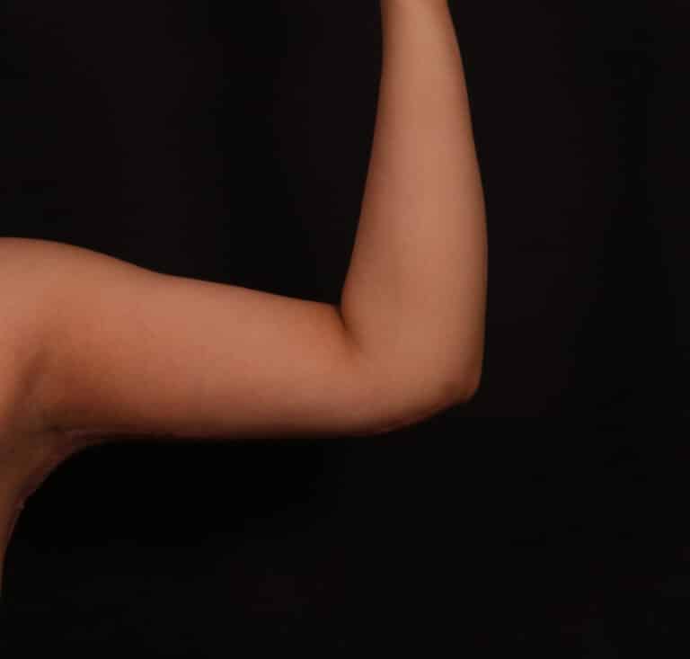 After Image: Brachioplasty - front