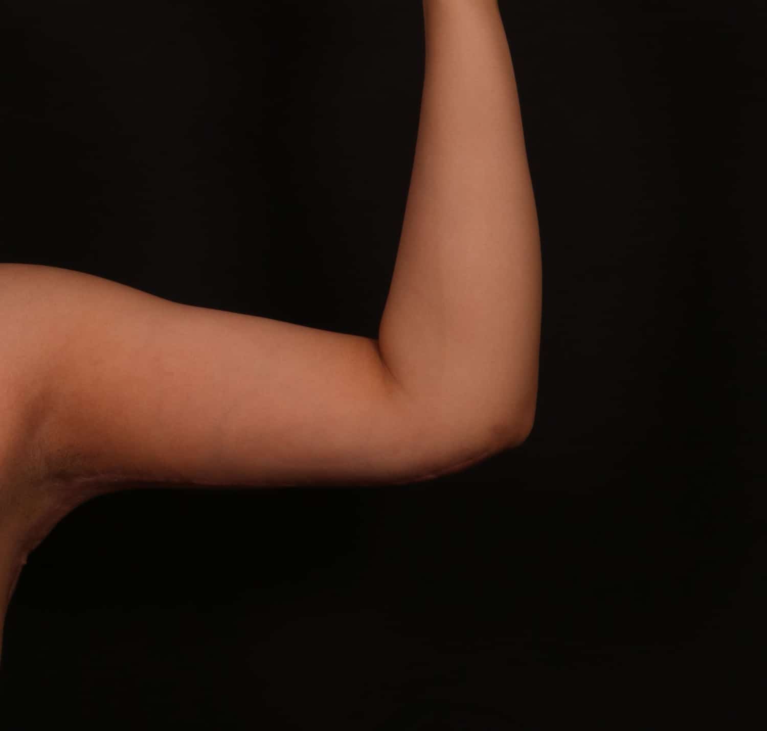 After Image: Brachioplasty - front