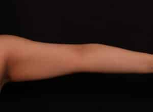 Before Image: Brachioplasty