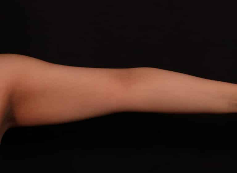 Before Image: Brachioplasty - front